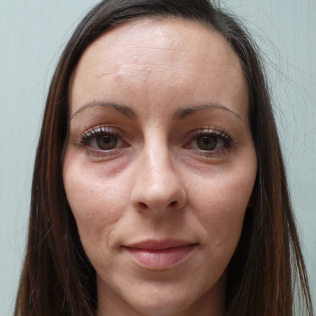 Brow lift before, front view