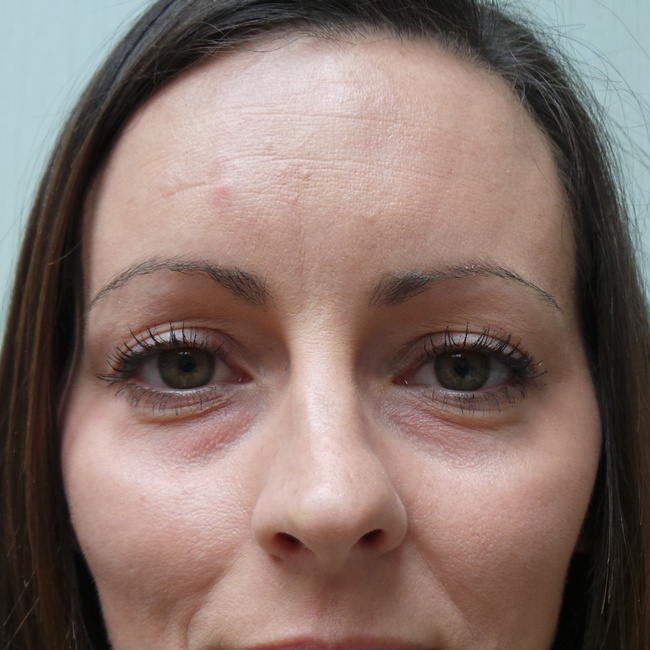 Brow lift before, close-up view