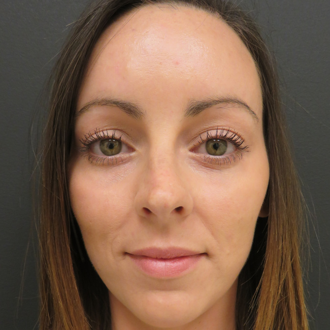 Brow lift after, front view