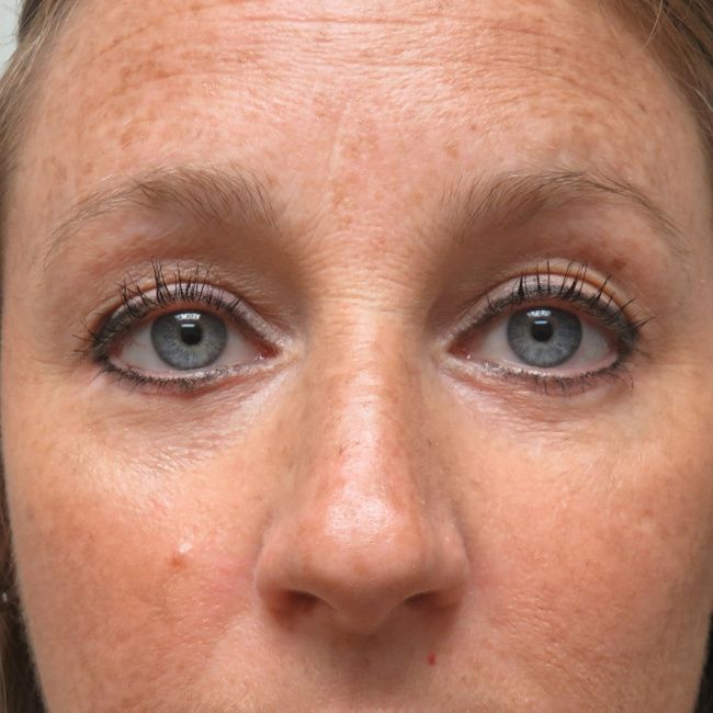 Eyelid surgery patient, close-up of the eyes