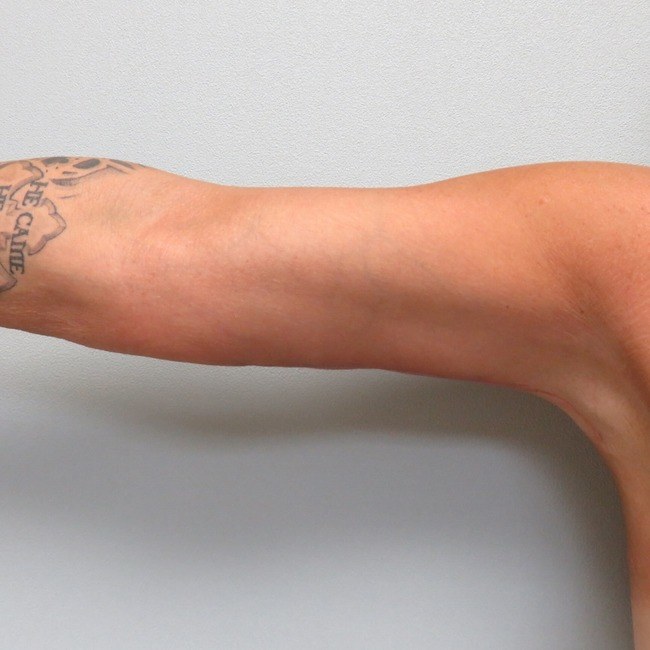 Liposuction and body contouring results