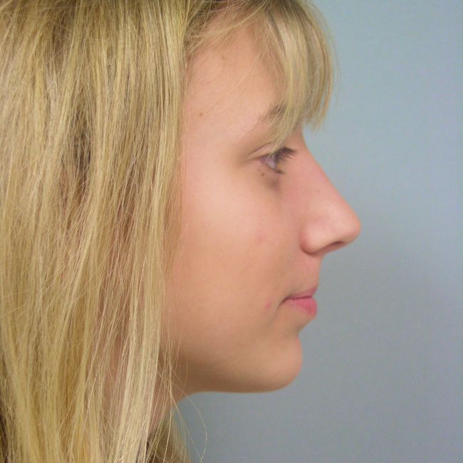 Rhinoplasty patient, profile view
