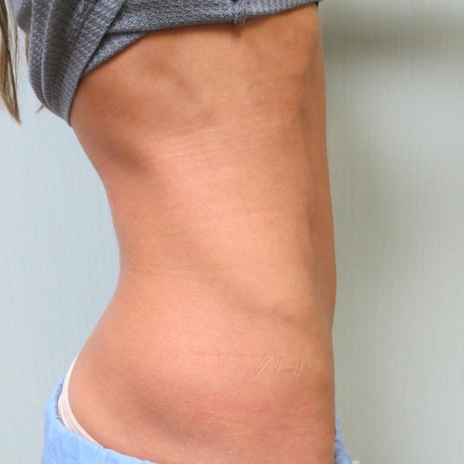 Tummy tuck results