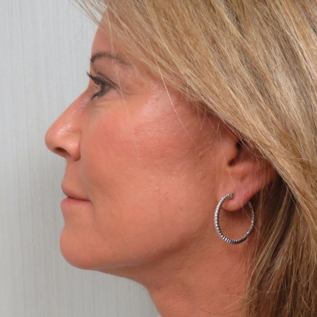 Facelift patient, profile view
