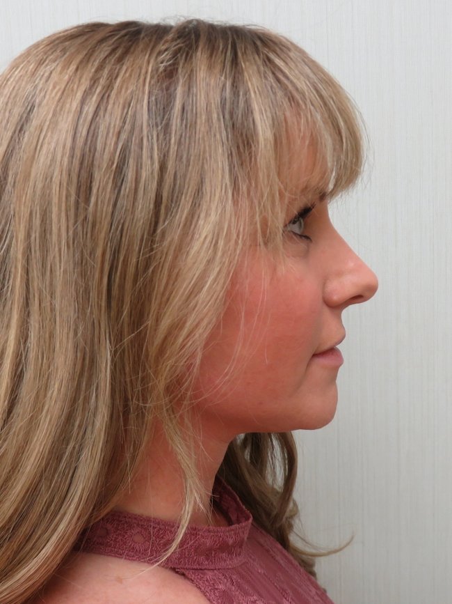 Facelift after, profile view