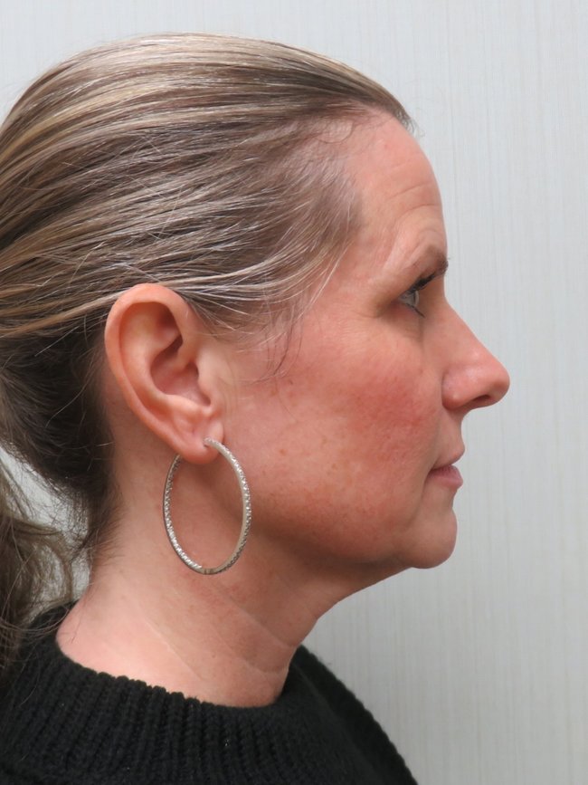 Facelift before, profile view