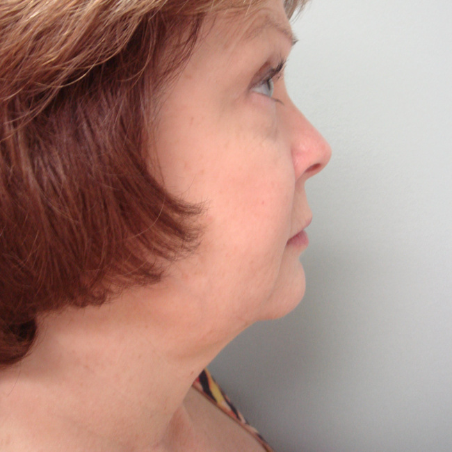 Neck lift before, profile view