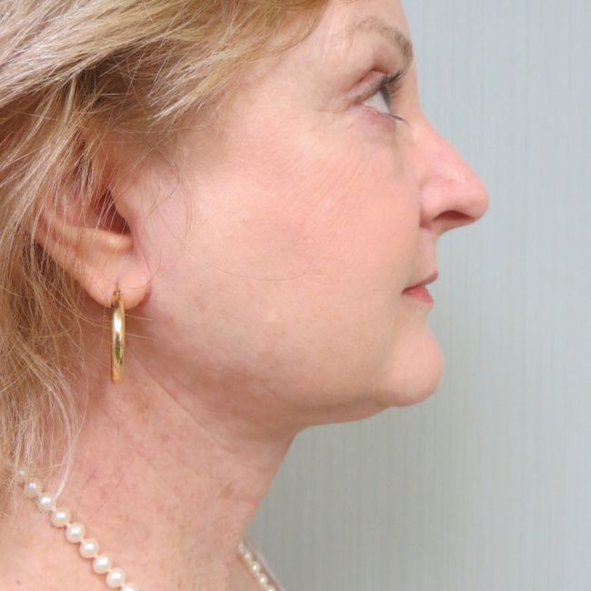 Neck lift result, profile view