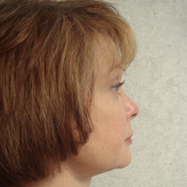 Neck lift after, profile view