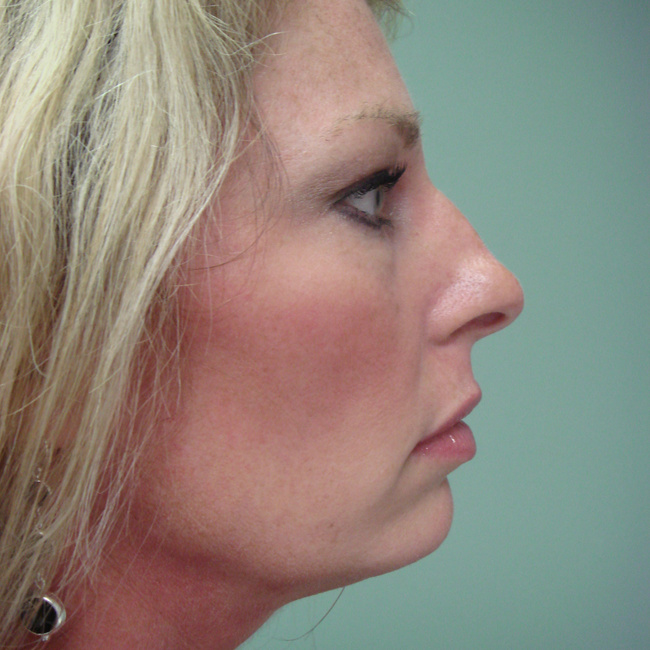 Rhinoplasty before, profile view