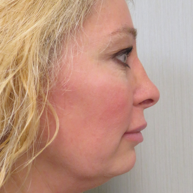 Rhinoplasty after, profile view