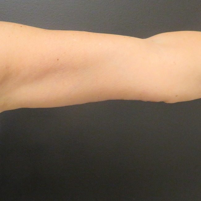 Arm Lift after