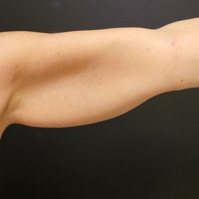 Arm Lift before