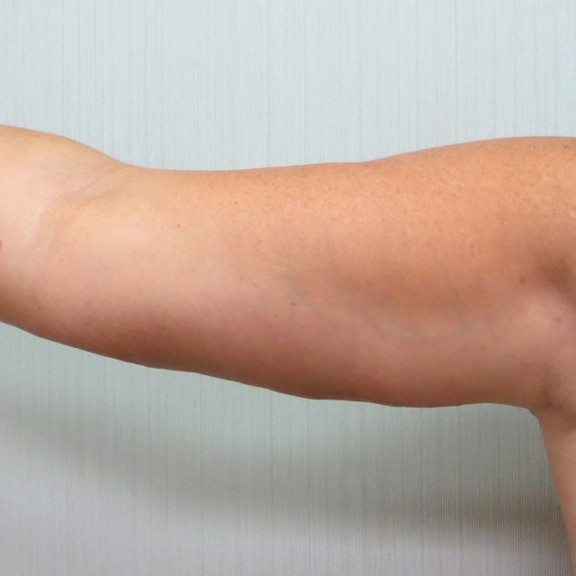 Arm Lift after
