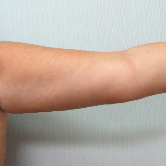 Arm Lift after