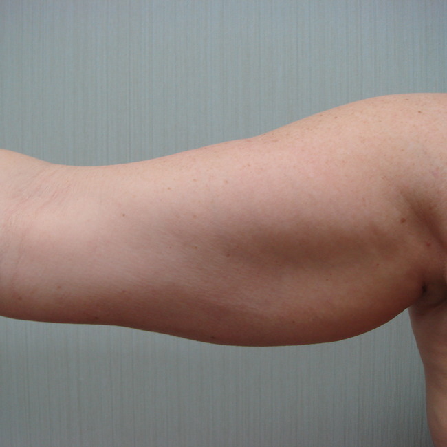 Arm Lift before