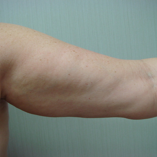 Arm Lift before