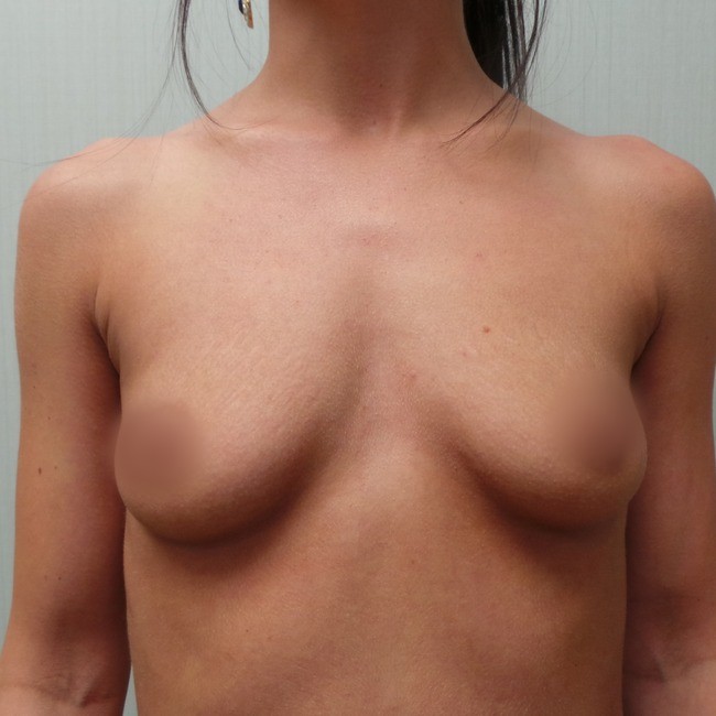 Breast Augmentation before