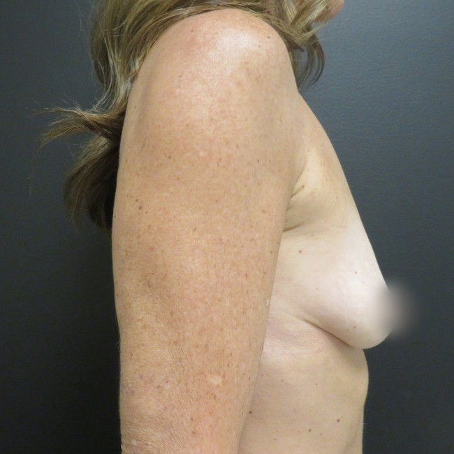 Breast Lift before