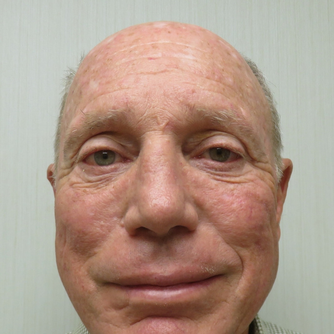 Brow Lift after