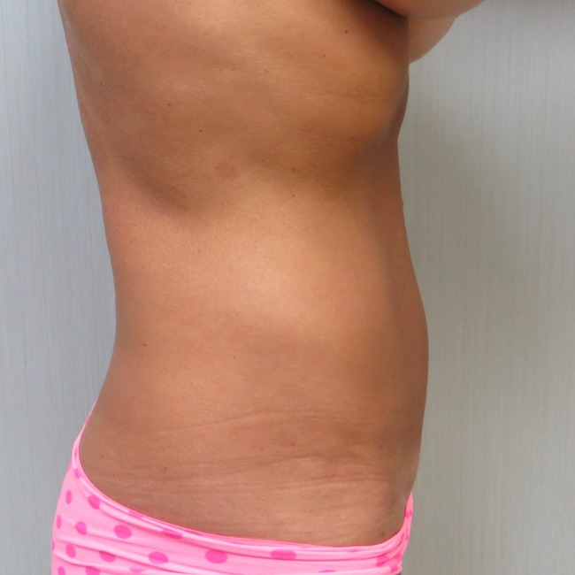 Mini Tummy Tuck after