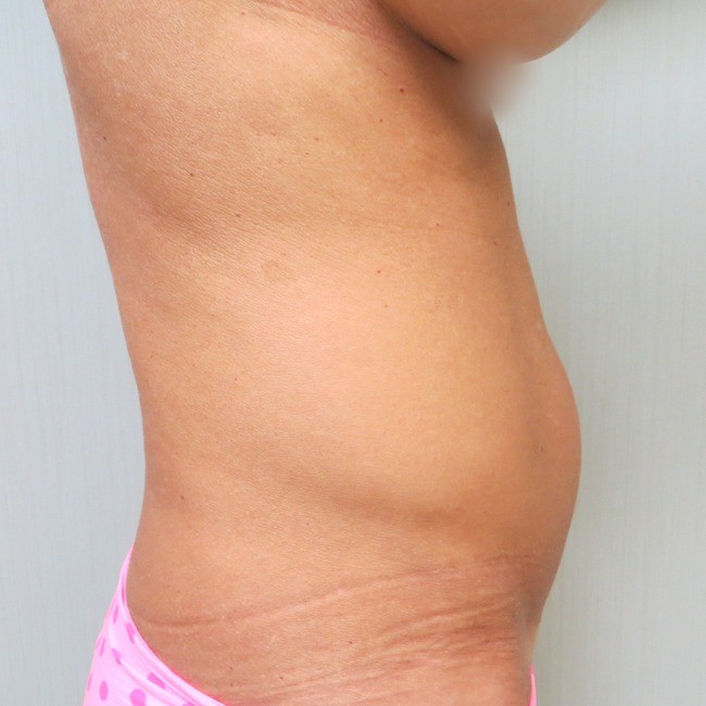 Mini Tummy Tuck before