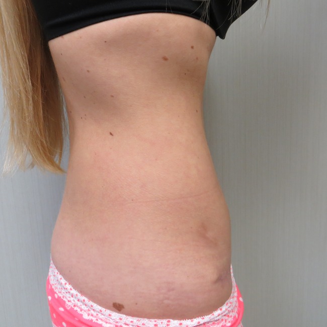 Mini Tummy Tuck after