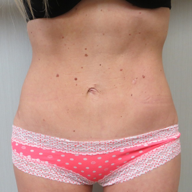 Mini Tummy Tuck after