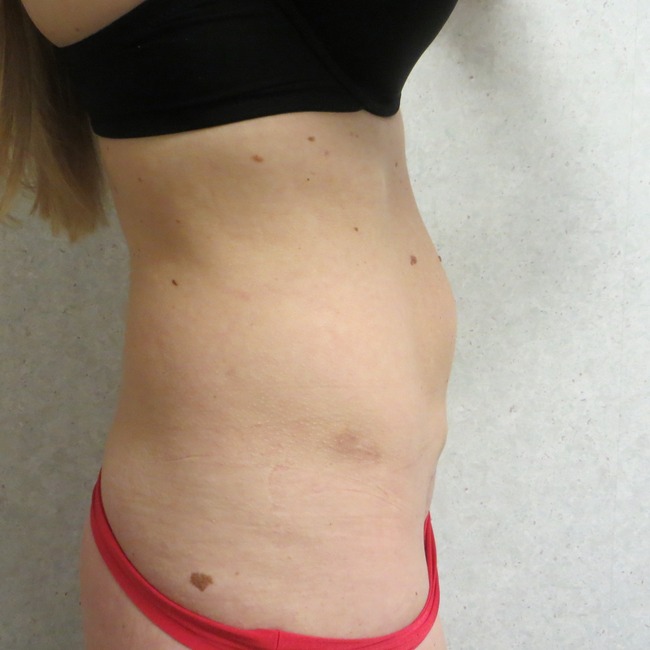 Mini Tummy Tuck before