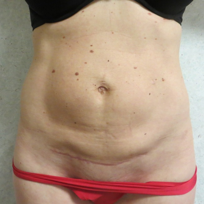Mini Tummy Tuck before