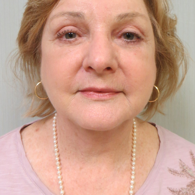 Neck Lift after