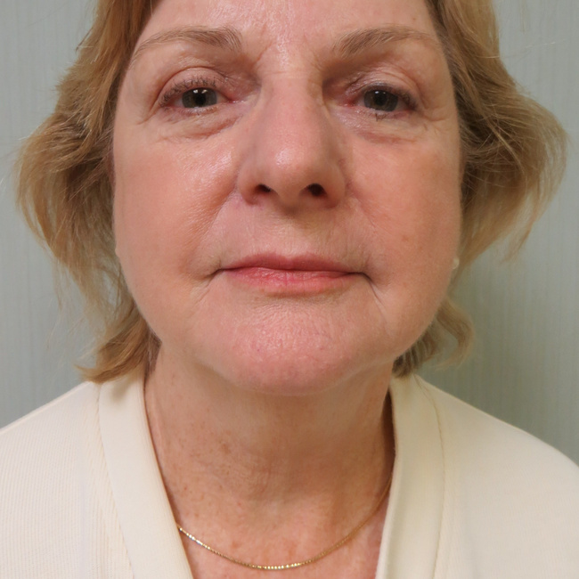 Neck Lift before