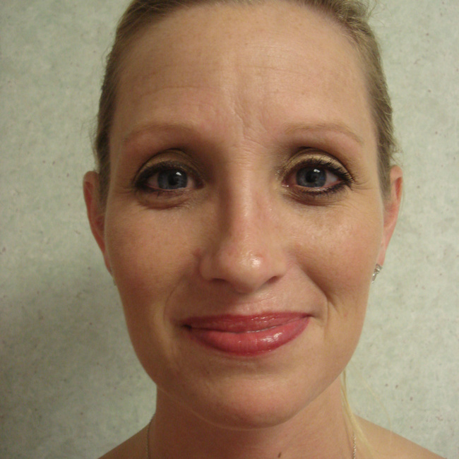 Rhinoplasty after