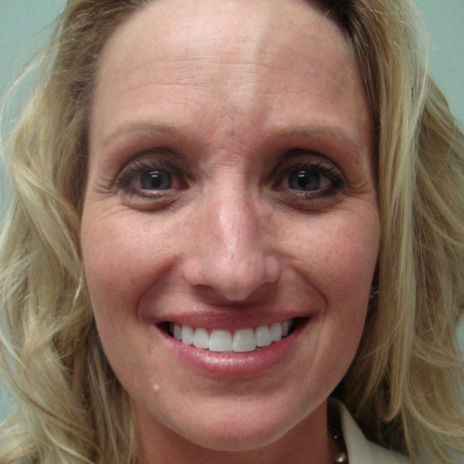 Rhinoplasty before