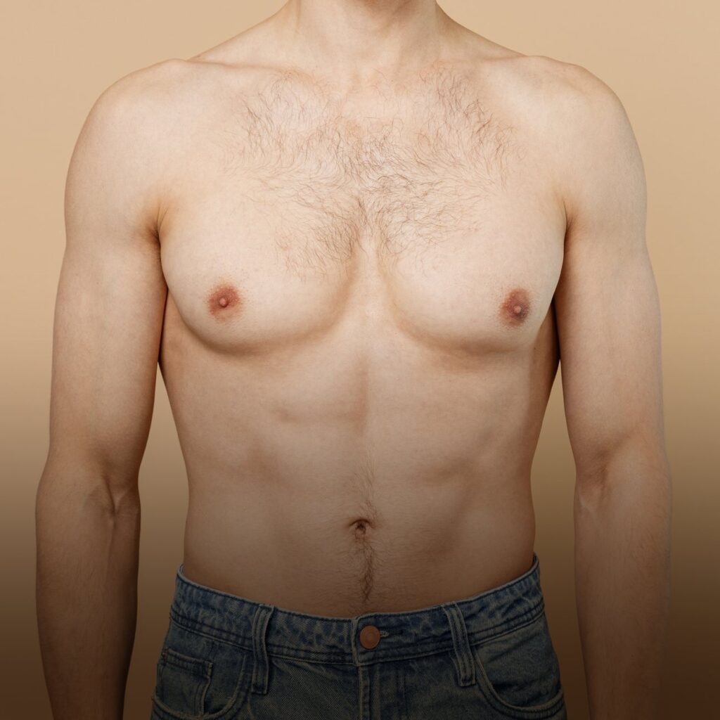 Tummy tuck for men