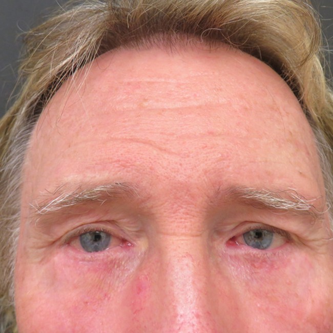 Brow Lift after