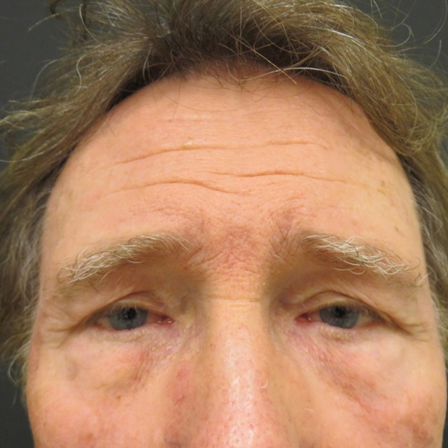 Brow Lift before