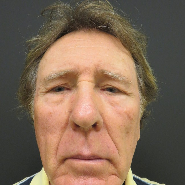Brow Lift before