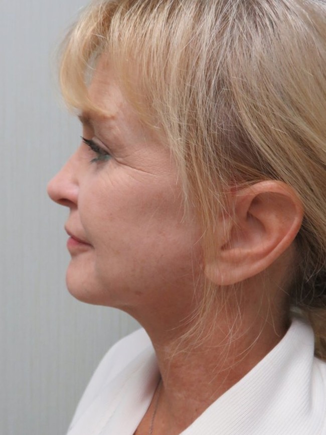 Facelift after