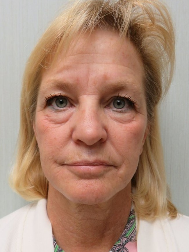 Facelift before