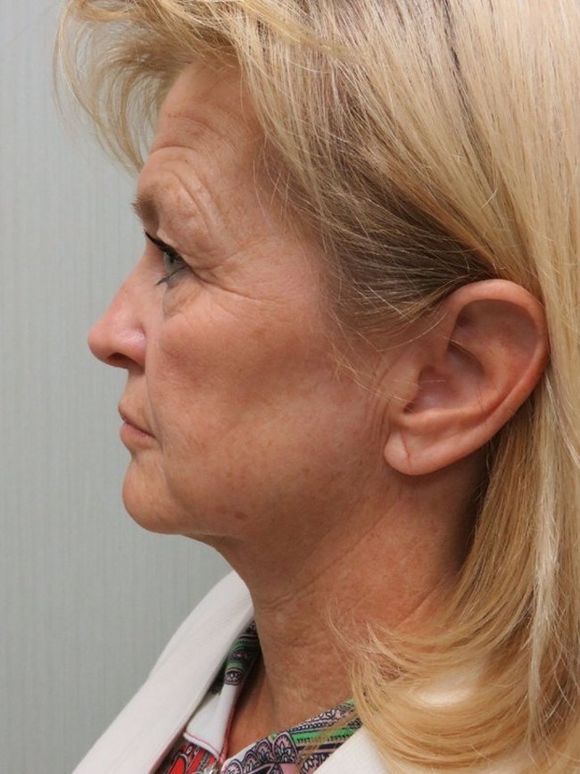 Facelift before