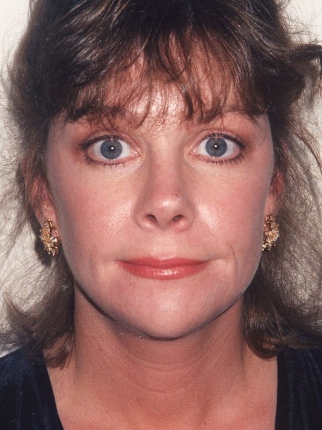 Facelift after