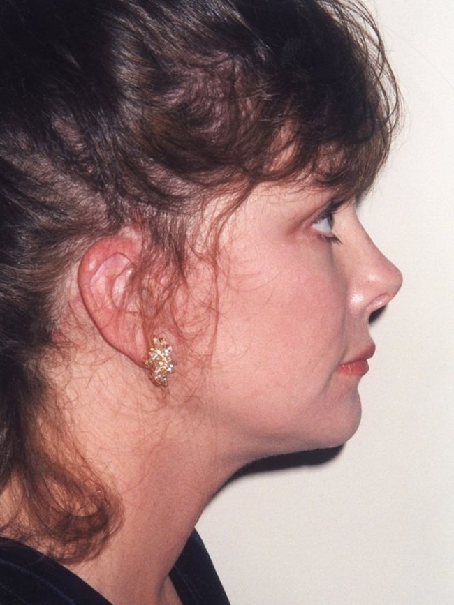 Facelift after