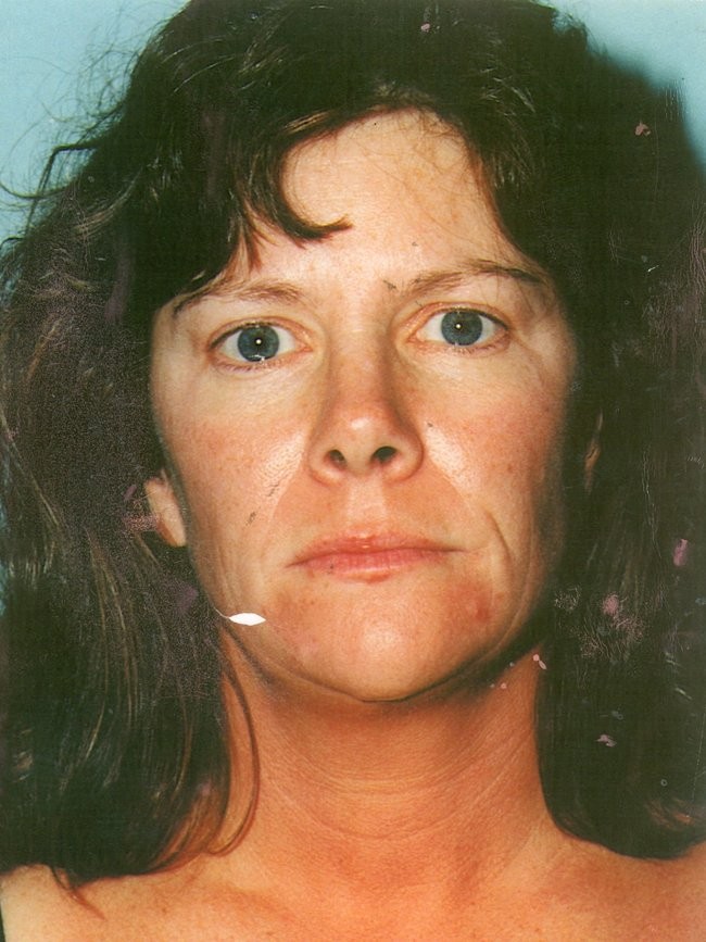 Facelift before