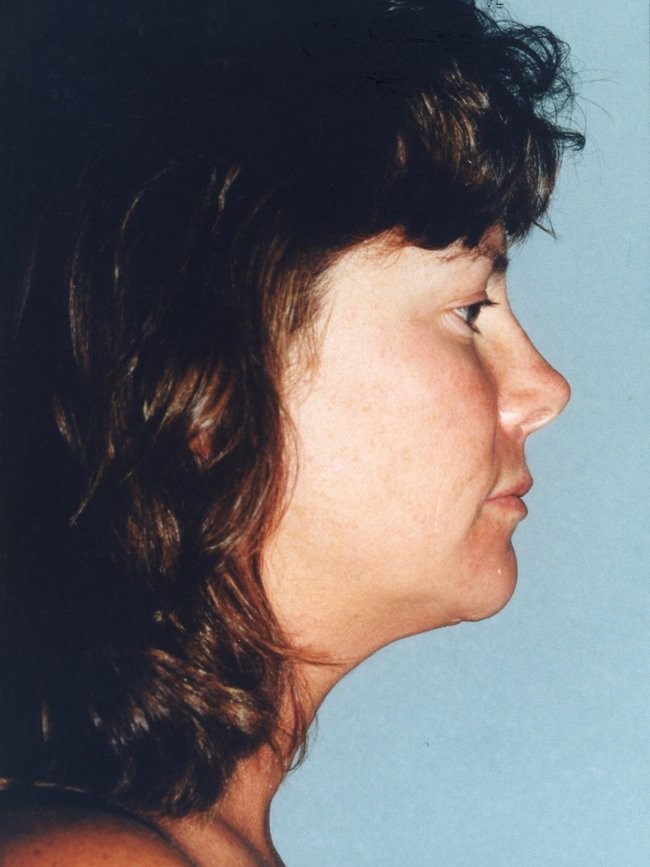 Facelift before