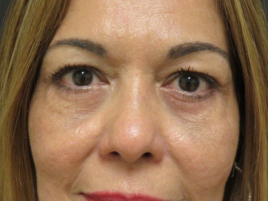 Lower Eyelid Surgery after