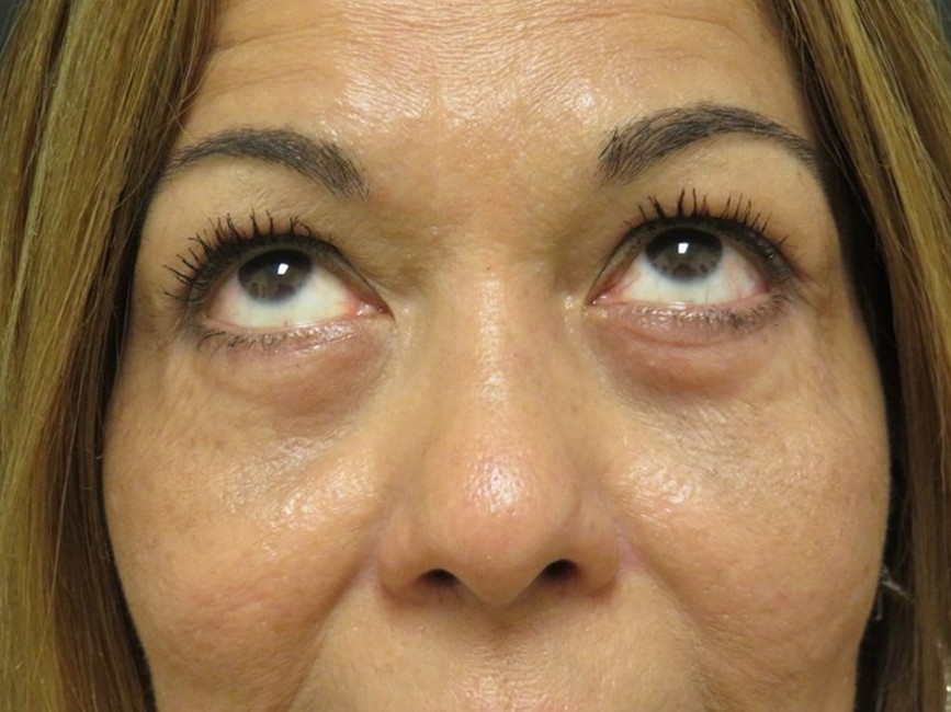 Lower Eyelid Surgery after
