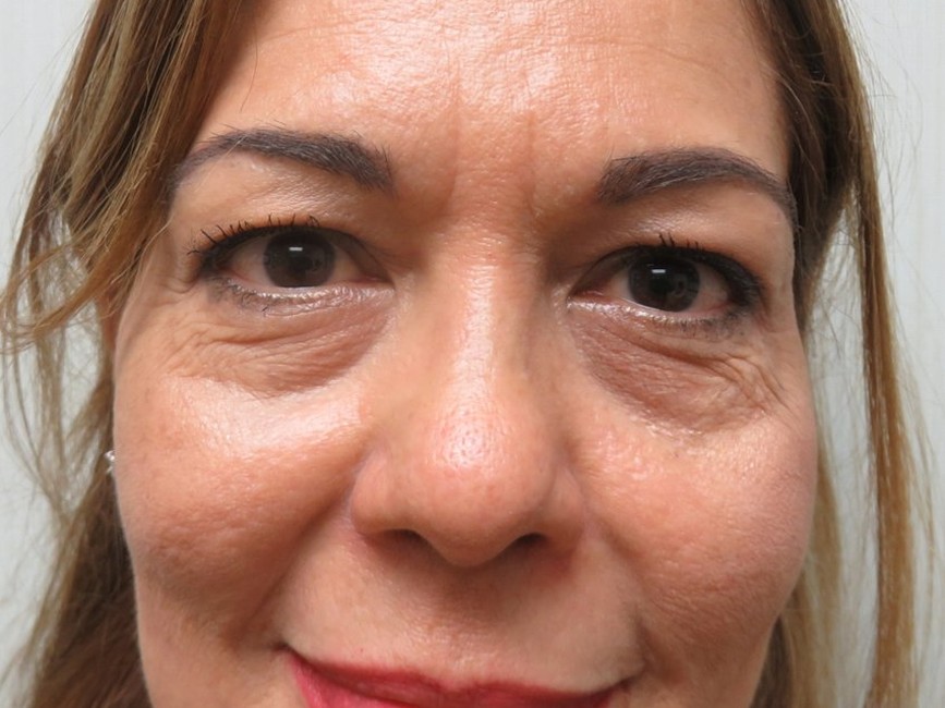 Lower Eyelid Surgery before