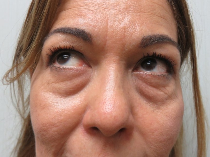 Lower Eyelid Surgery before