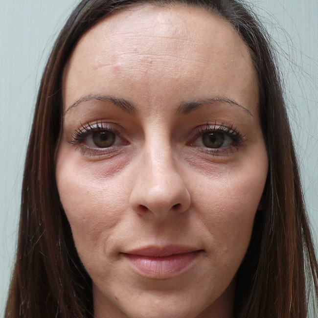 Brow lift before, front view